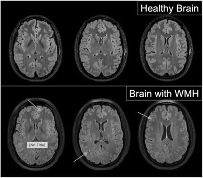 Cardiovascular profiles associated with white matter hyperintensities in healthy young women